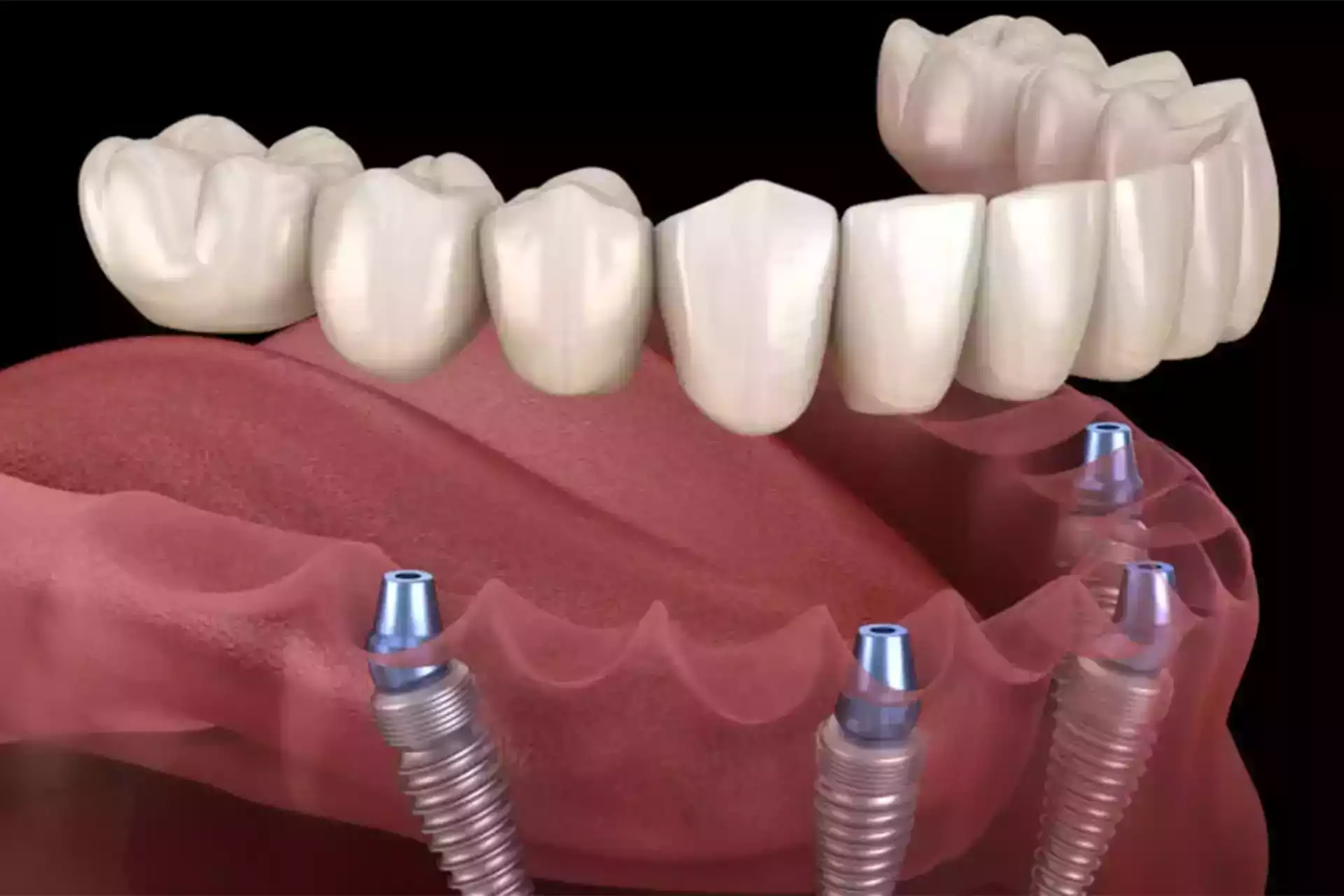 All-on-4 dental inplants