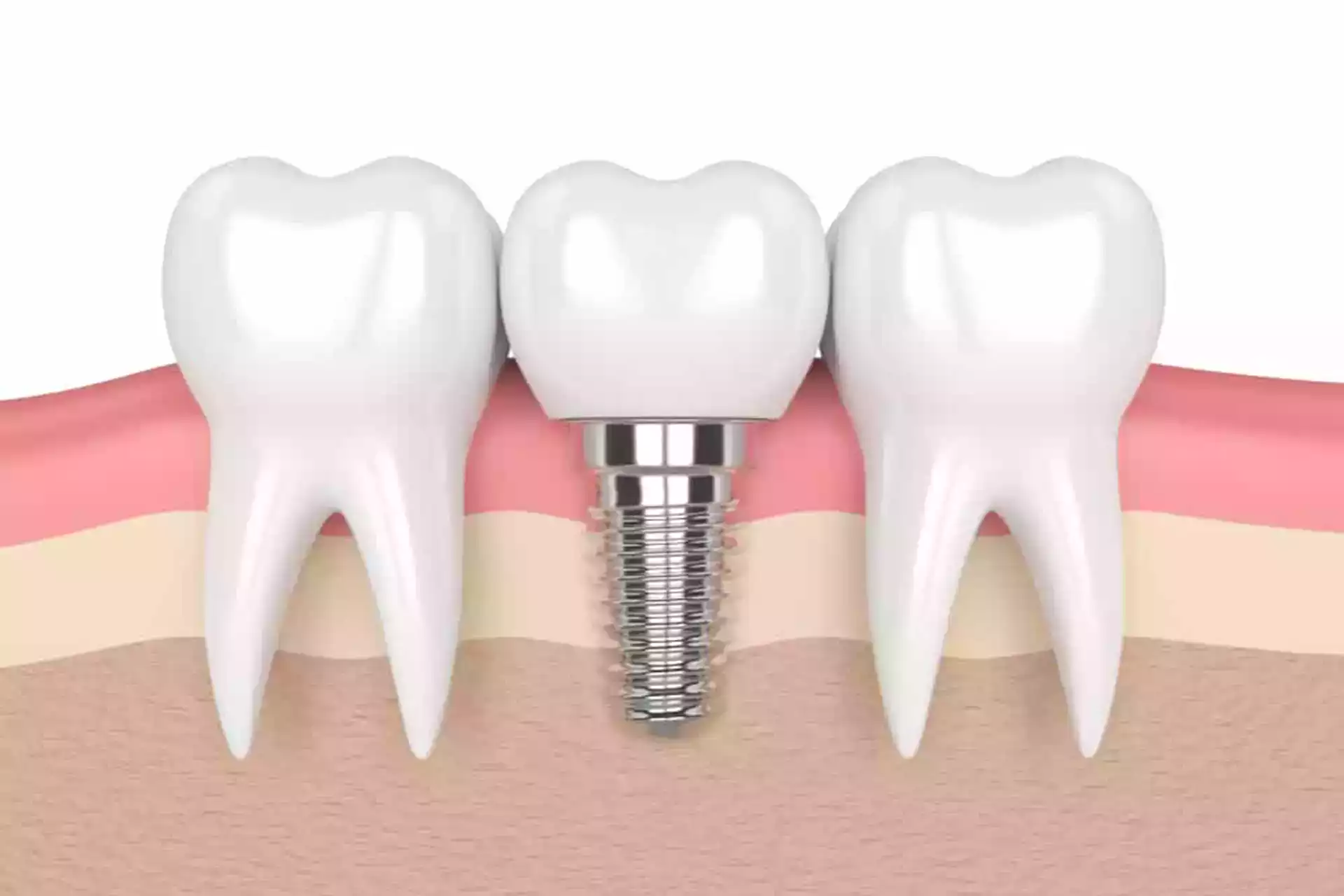 Dental implants cost in Turkey