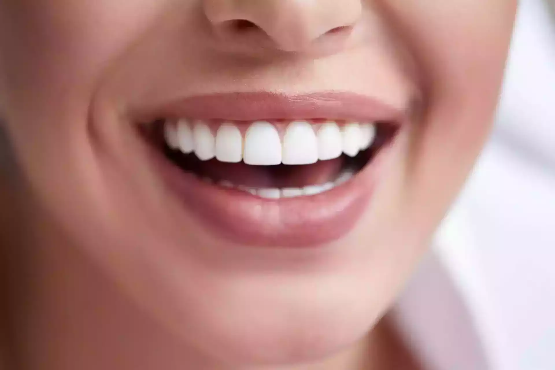Dental veneers smile