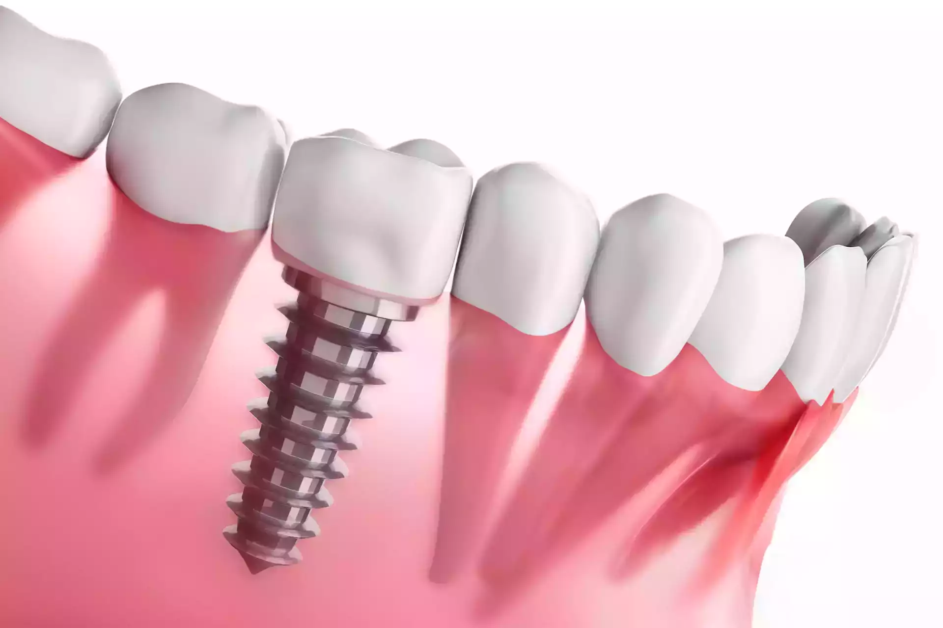 Le coût des implants dentaires en Turquie