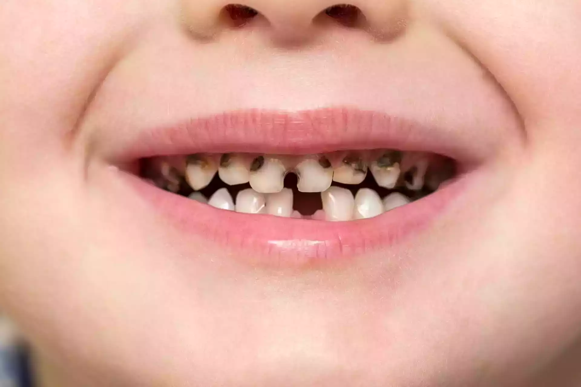 Rotten Teeth Signs & Symptoms