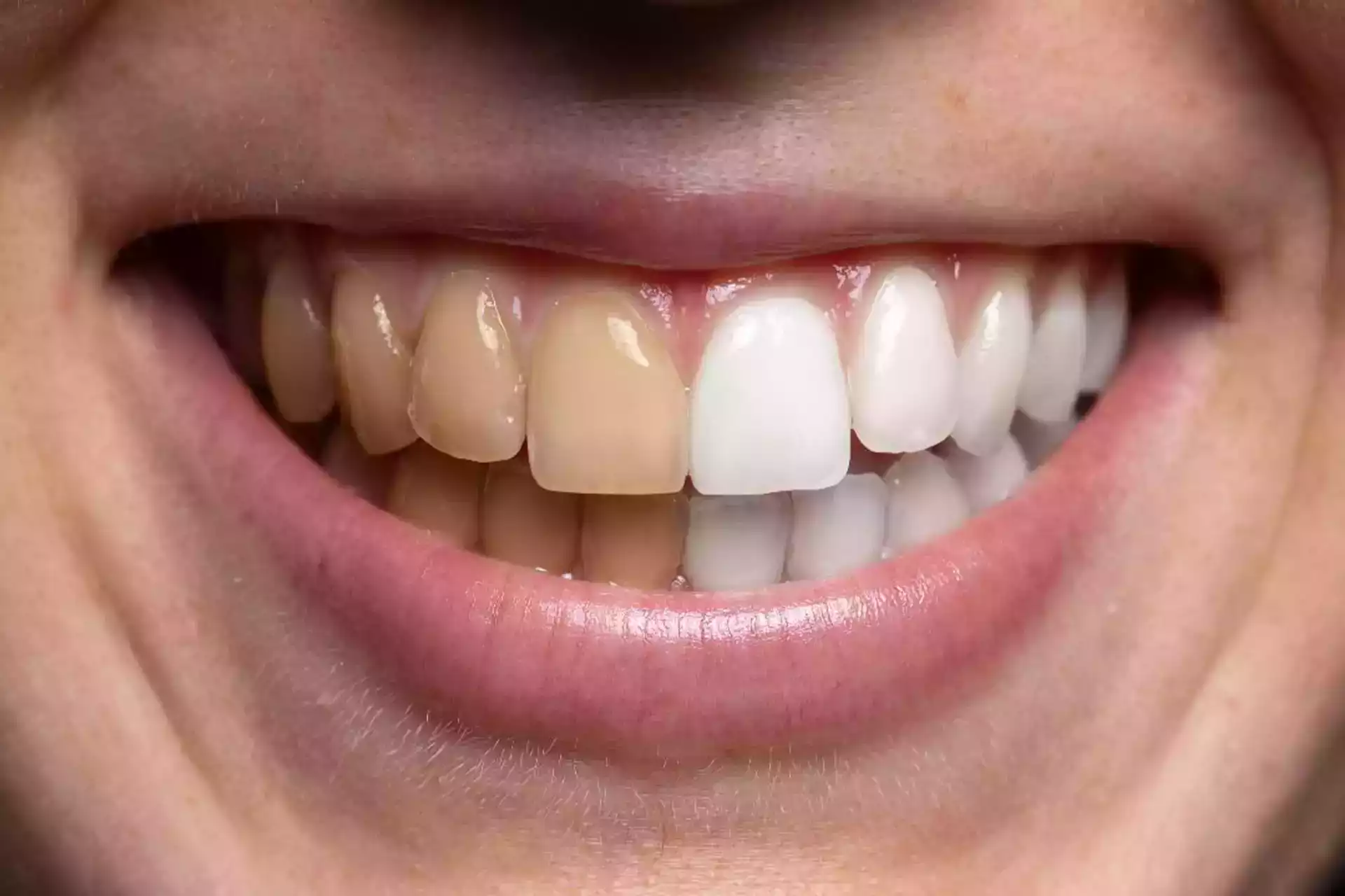Quelles sont les principales causes des taches sur les dents ?