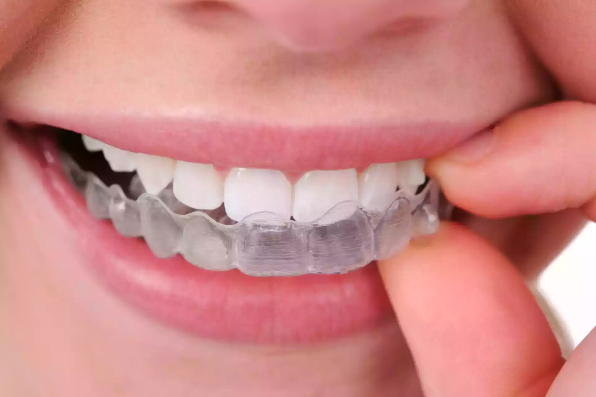 Invisalign braces- what are they and their benefits?