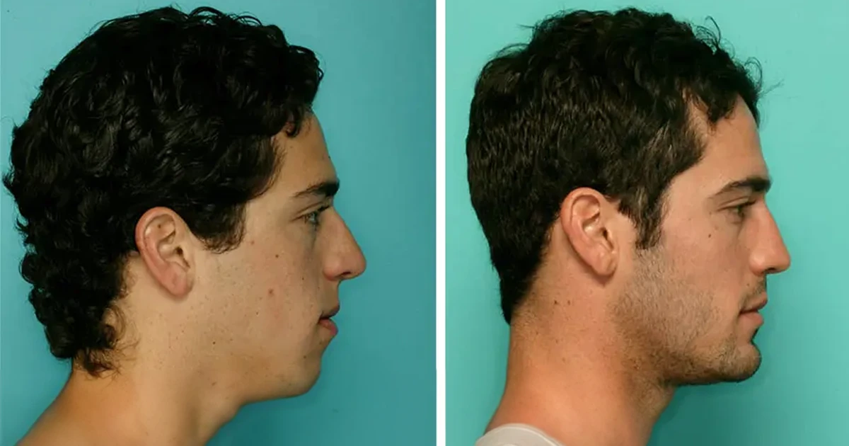 Cirugía de mandíbula antes y después.