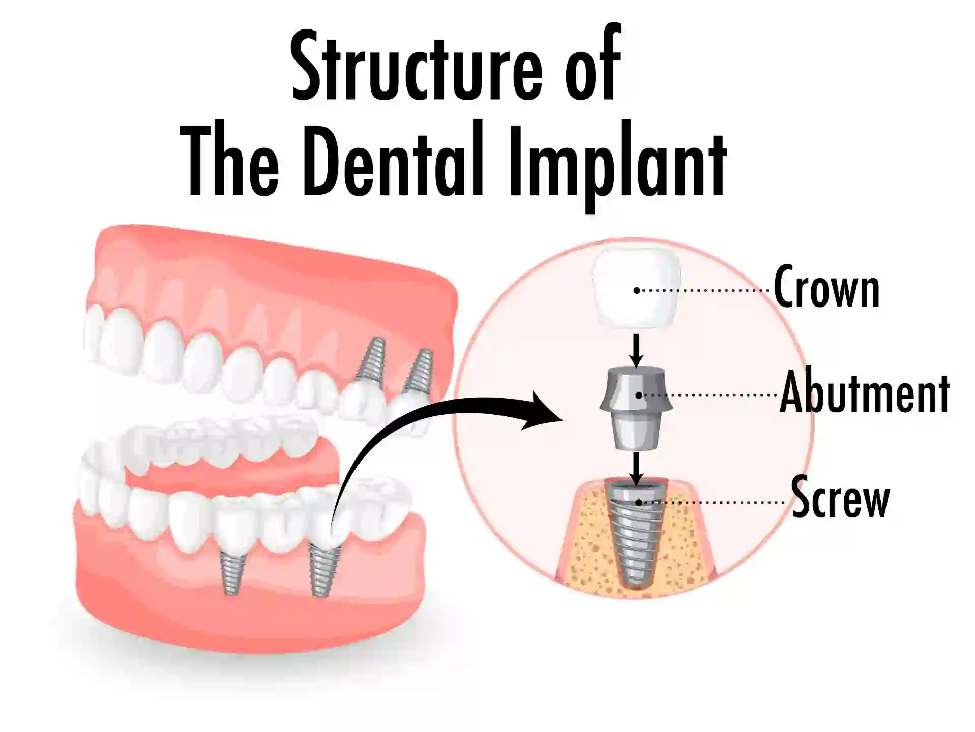 Structure of dental implants in Turkey