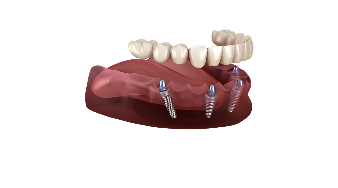 Implantes dentales All-On-4 