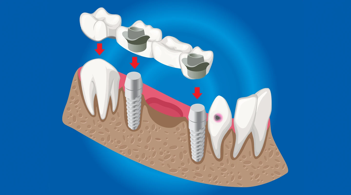 Tratamiento con puentes dentales 