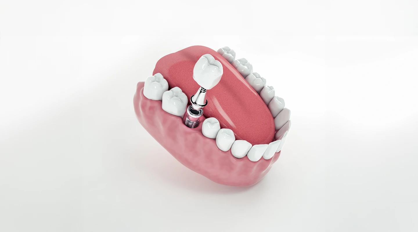 Coronas dentales 