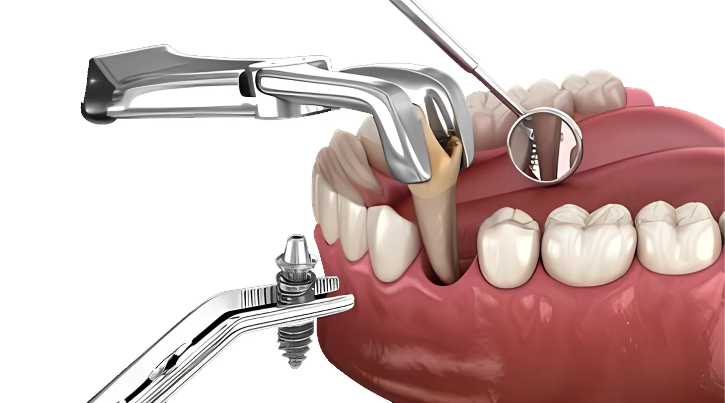 Implants dentaires immédiats