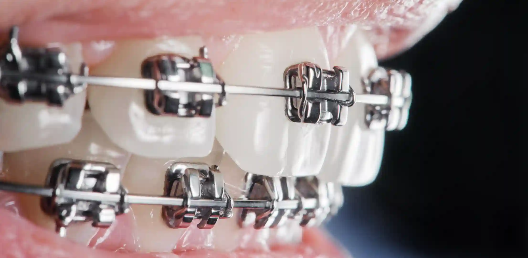 Metal dental braces closeup