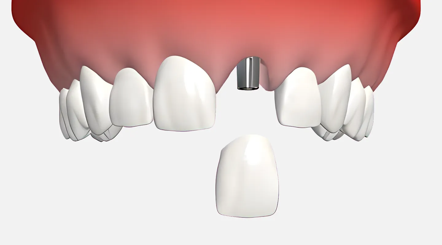 Implante dental unitario 