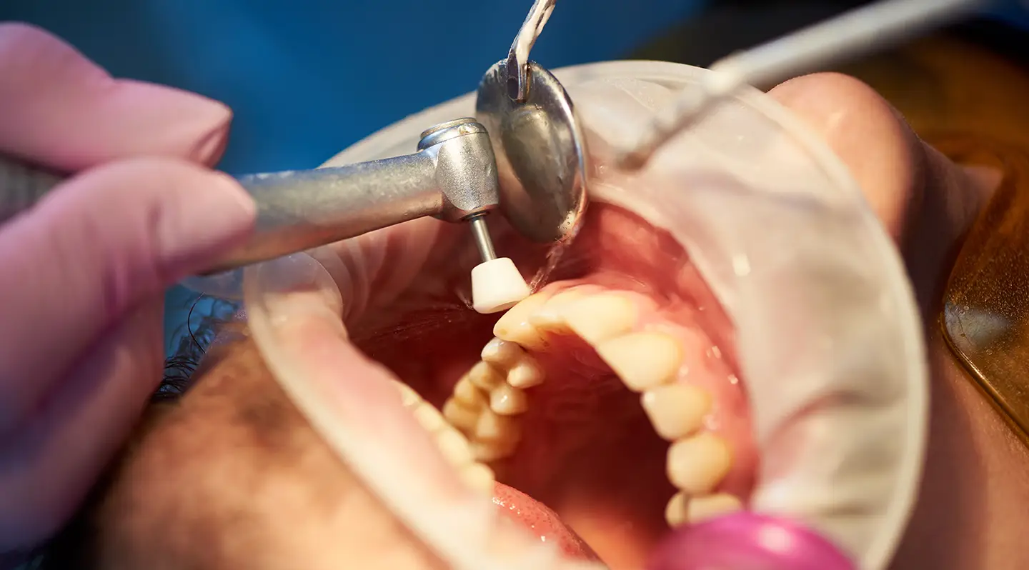 Teeth scaling and polishing in Turkey