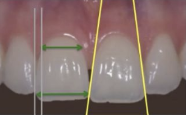 normal form of teeth Les dents ayant une forme triangulaire