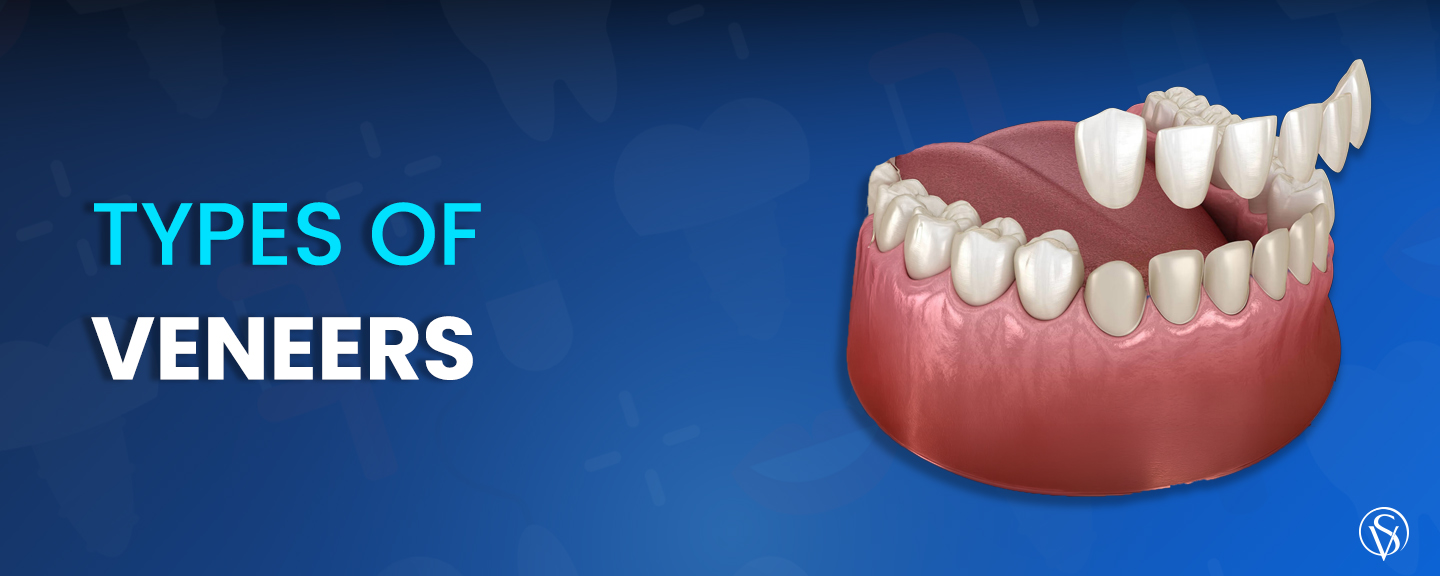 types of dental veneers