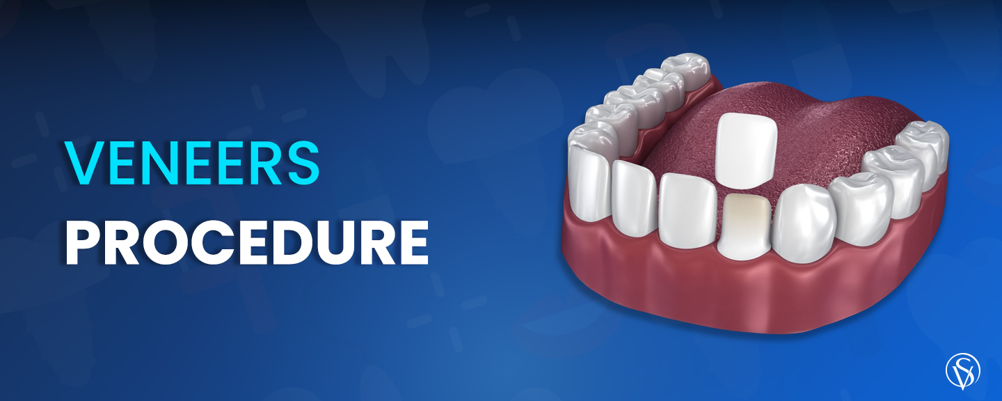 veneers procedure
