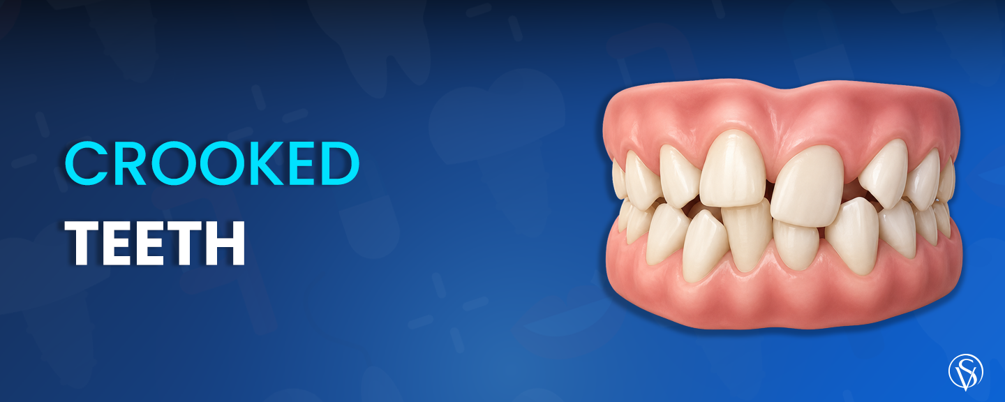 crooked teeth