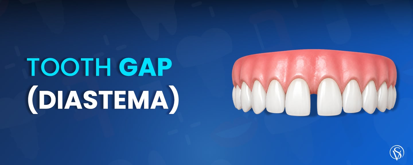 Tooth Gap (Diastema)