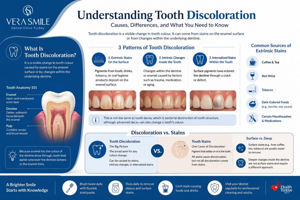 The infographic explains tooth discoloration and how it differs from tooth stains. It begins with a definition stating that tooth discoloration is a visible change in tooth colour caused either by stains on the enamel surface or by changes within the underlying dentine. An anatomical illustration labels enamel as the hard, semi-translucent outer layer, dentine as the darker yellowish tissue beneath it, and the pulp as the inner tissue containing nerves and blood vessels. It notes that because enamel is translucent, teeth appear darker when dentine darkens or enamel becomes thinner. The central section identifies three patterns of tooth discoloration: extrinsic stains on the enamel surface caused by external pigments; intrinsic changes occurring inside the tooth due to factors such as ageing, trauma, or medication; and internalized stains, where pigments penetrate the dentine through cracks or defects. Example illustrations accompany each category. A note clarifies that tooth discoloration is different from tooth decay, although advanced decay can also change tooth colour. A comparison panel explains that tooth discoloration is the broad term for any change in tooth colour, while tooth stains are one specific cause involving pigment deposited on or within the tooth. It emphasizes that all stains cause discoloration, but not all discoloration results from stains because intrinsic changes occur without external pigments. The infographic also distinguishes surface stains, which are generally easier to remove, from deeper dentine colour changes that require different treatment approaches. A sidebar lists common sources of extrinsic stains, including coffee and tea, red wine, tobacco, dark-coloured foods, and certain mouthwashes or medications. The footer recommends daily brushing with fluoride toothpaste, flossing, limiting stain-causing foods and drinks, and visiting a dentist regularly for professional cleaning and advice.