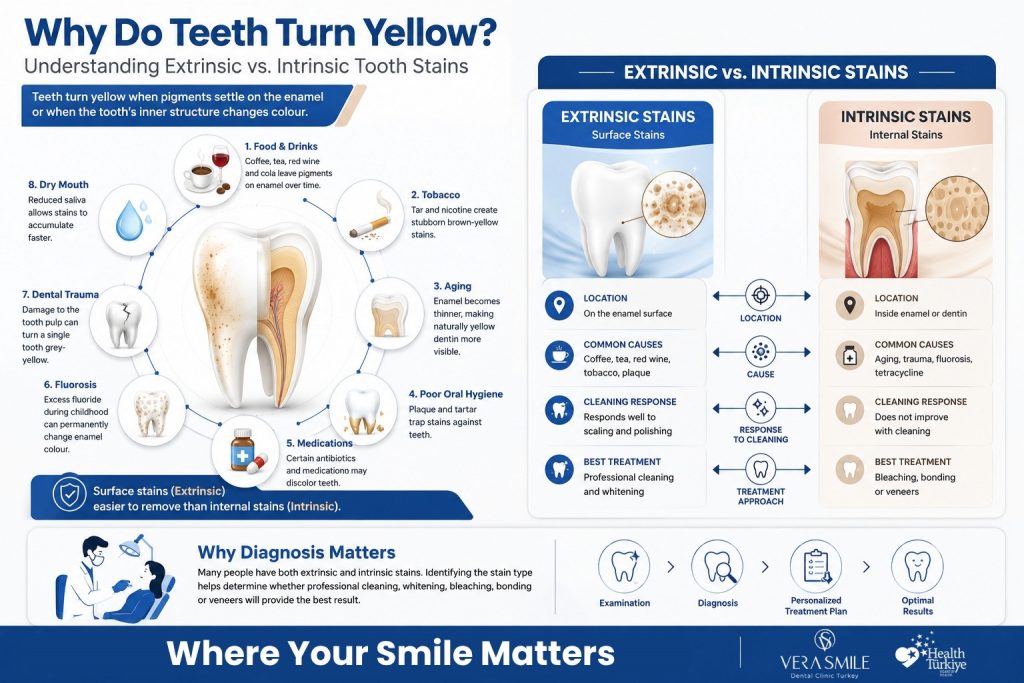 The infographic is divided into two main sections. The left section centers on a tooth illustration surrounded by eight labelled causes of tooth discoloration: food and drinks, tobacco, aging, poor oral hygiene, medications, fluorosis, dental trauma, and dry mouth. A highlighted note explains that extrinsic stains affect the tooth surface and are generally easier to remove than intrinsic stains. The right section compares extrinsic and intrinsic stains in two side-by-side panels. Extrinsic stains are located on the enamel surface, commonly caused by coffee, tea, red wine, tobacco, and plaque, respond well to professional cleaning, and are typically treated with scaling, polishing, or whitening. Intrinsic stains occur within the enamel or dentin, are associated with aging, trauma, fluorosis, and tetracycline exposure, do not respond to routine cleaning, and may require bleaching, bonding, or veneers. A concluding banner emphasizes that many people have both stain types and that a dental examination is necessary to determine the most appropriate treatment.