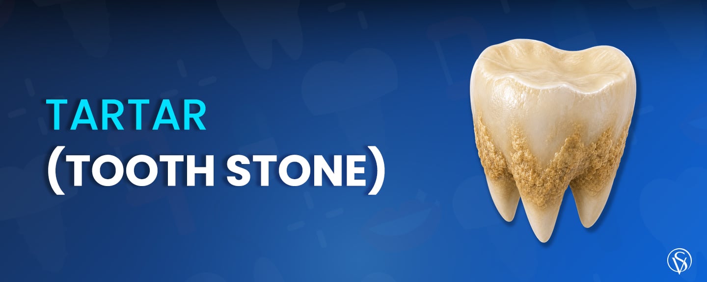 ⁠Tartar (Tooth Stone)