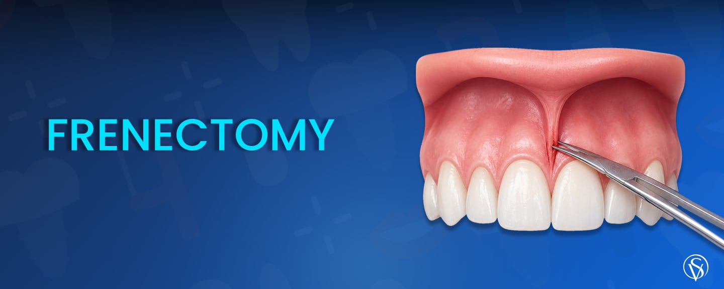 Frenectomy
