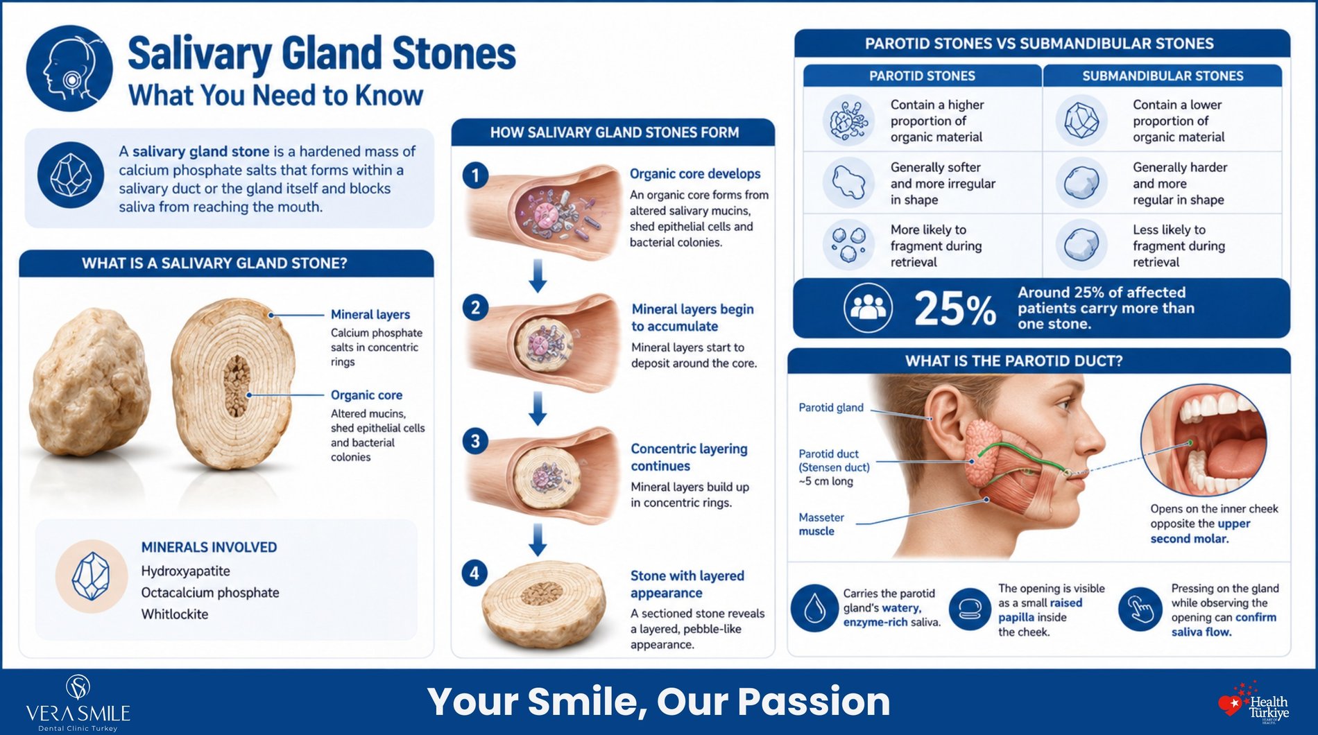 salivary gland stones and how they form. It shows a stone with an organic core surrounded by concentric mineral layers, followed by a four-step formation sequence. It identifies hydroxyapatite, octacalcium phosphate, and whitlockite as the minerals involved. A comparison section describes parotid stones as having more organic material, being softer and more irregular, and more likely to fragment during retrieval. It also states that around 25% of affected patients carry more than one stone. The final section illustrates the parotid gland and Stensen duct, approximately 5 cm long, as it passes across the masseter muscle and opens on the inner cheek opposite the upper second molar