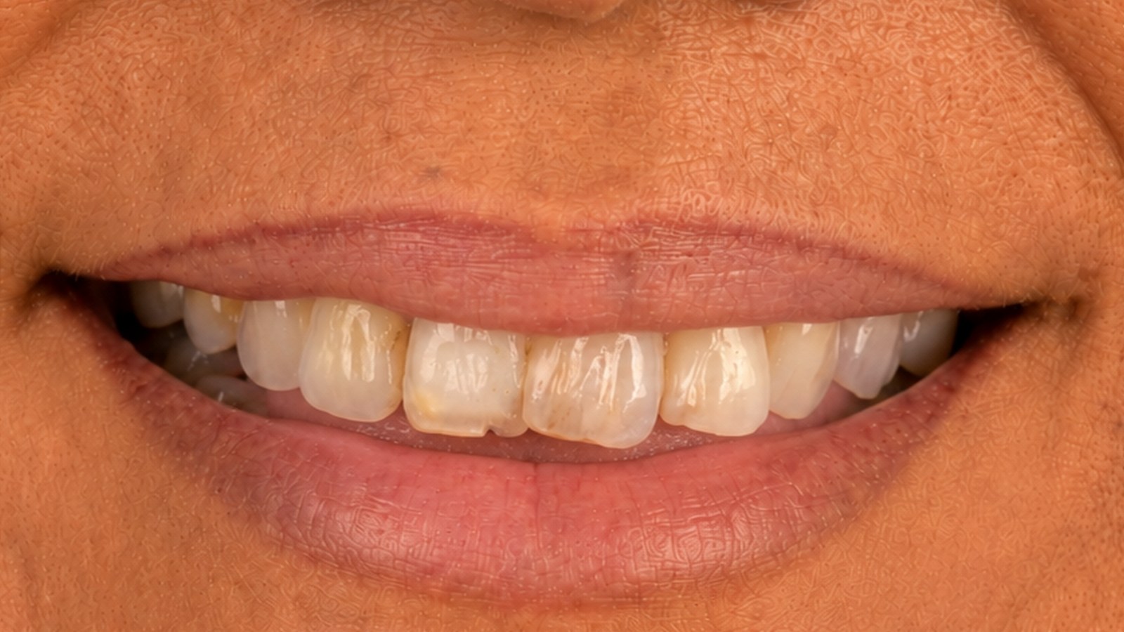 Antes — frontal